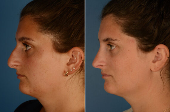 Rhinoplasty Before and After Photos in Naples, FL, Patient 24737
