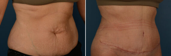 Abdominoplasty Before and After Photos in Naples, FL, Patient 25026