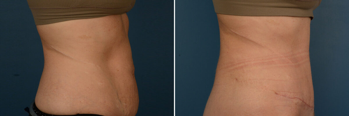 Abdominoplasty Before and After Photos in Naples, FL, Patient 25026