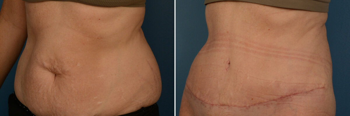 Abdominoplasty Before and After Photos in Naples, FL, Patient 25026