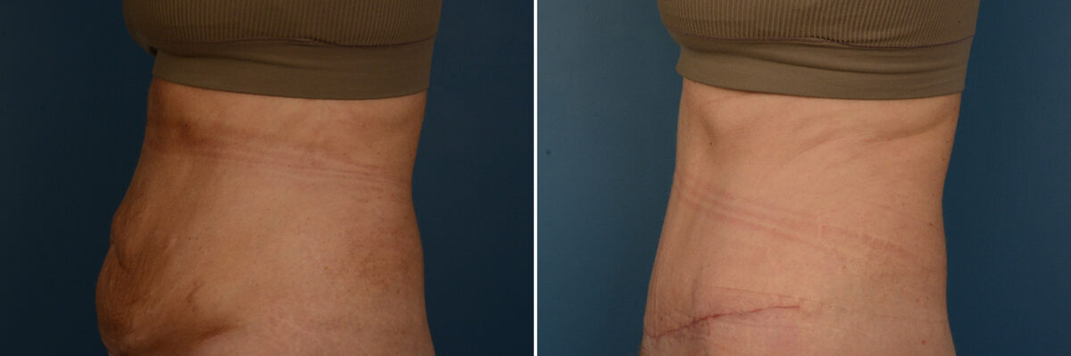 Abdominoplasty Before and After Photos in Naples, FL, Patient 25026