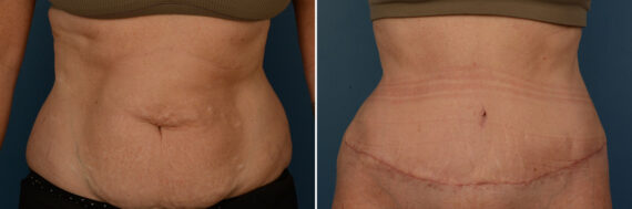 Abdominoplasty Before and After Photos in Naples, FL, Patient 25026