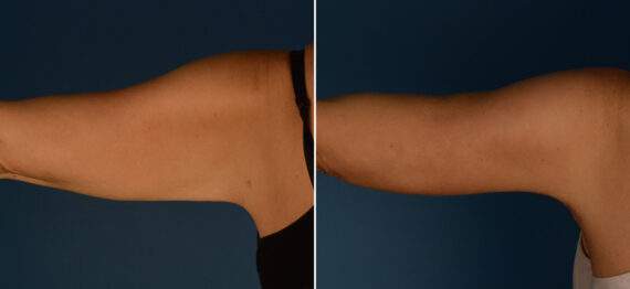 Arm Lift Before and After Photos in Naples, FL, Patient 25044