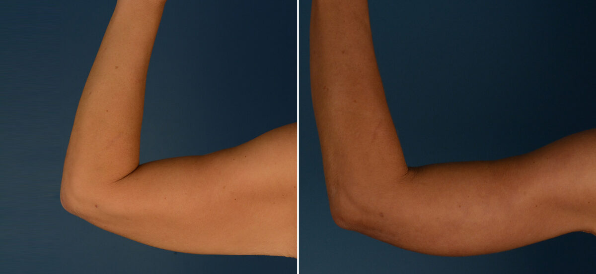 Arm Lift Before and After Photos in Naples, FL, Patient 25044