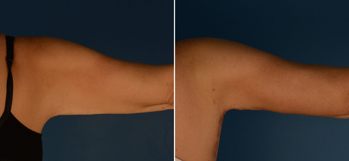 Arm Lift Before and After Photos in Naples, FL, Patient 25044