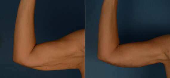 Arm Lift Before and After Photos in Naples, FL, Patient 25044