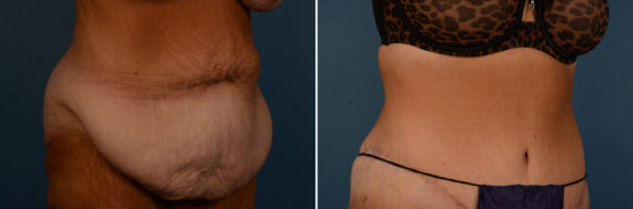 Abdominoplasty Before and After Photos in Naples, FL, Patient 25151