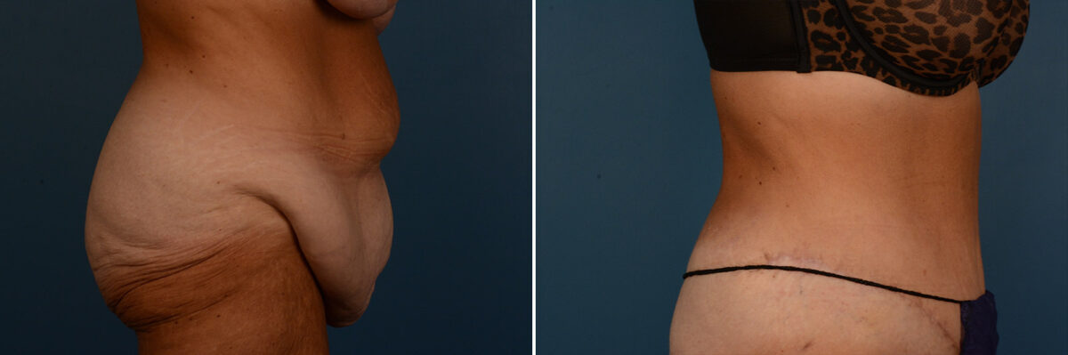 Abdominoplasty Before and After Photos in Naples, FL, Patient 25151