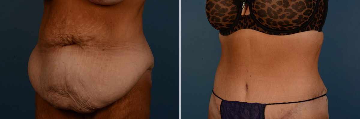 Abdominoplasty Before and After Photos in Naples, FL, Patient 25151