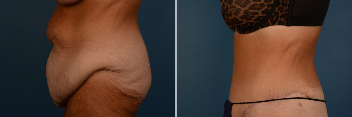 Abdominoplasty Before and After Photos in Naples, FL, Patient 25151