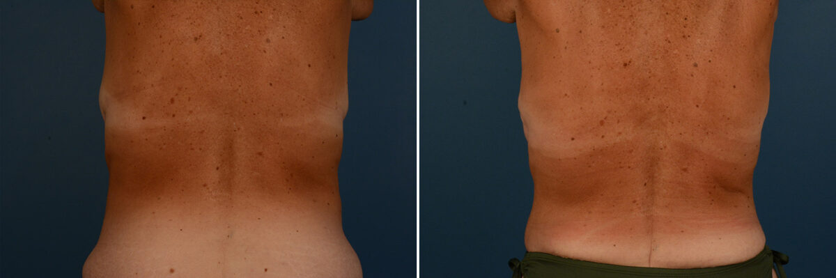 Abdominoplasty Before and After Photos in Naples, FL, Patient 25151