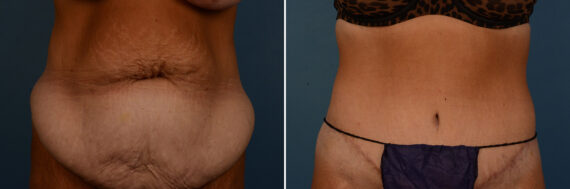 Abdominoplasty Before and After Photos in Naples, FL, Patient 25151