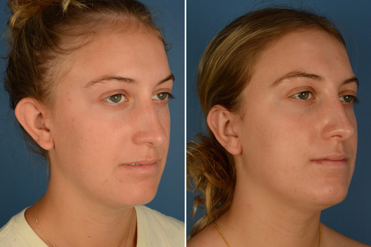 Otoplasty Before and After Photos in Naples, FL, Patient 25171