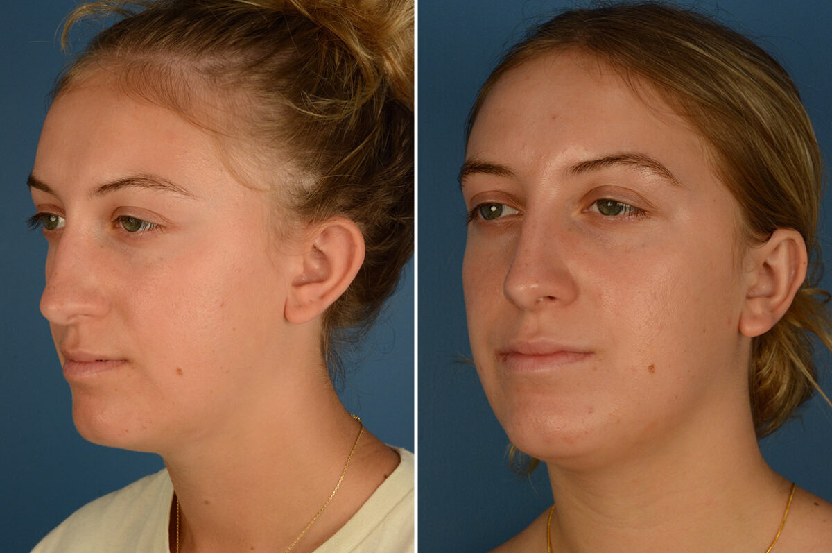 Otoplasty Before and After Photos in Naples, FL, Patient 25171