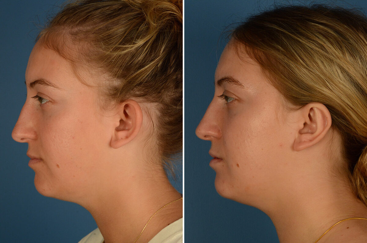 Otoplasty Before and After Photos in Naples, FL, Patient 25171