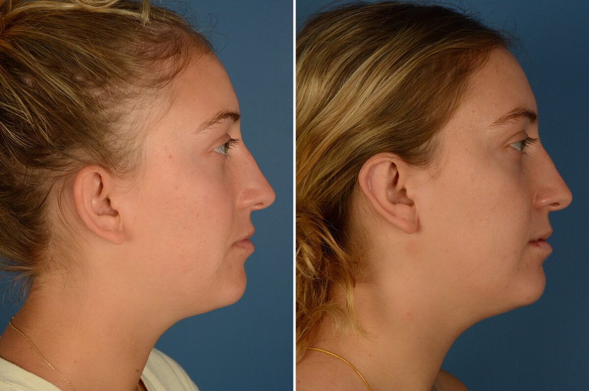 Otoplasty Before and After Photos in Naples, FL, Patient 25171