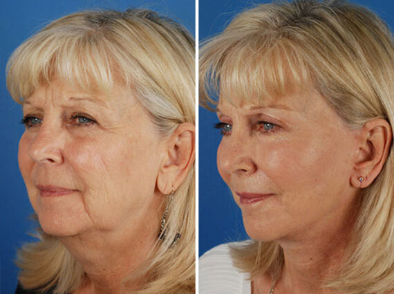 Endoscopic Facelift Before and After Photos in Naples, FL, Patient 8463