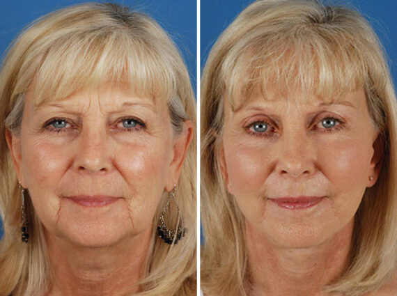 Endoscopic Facelift Before and After Photos in Naples, FL, Patient 8463