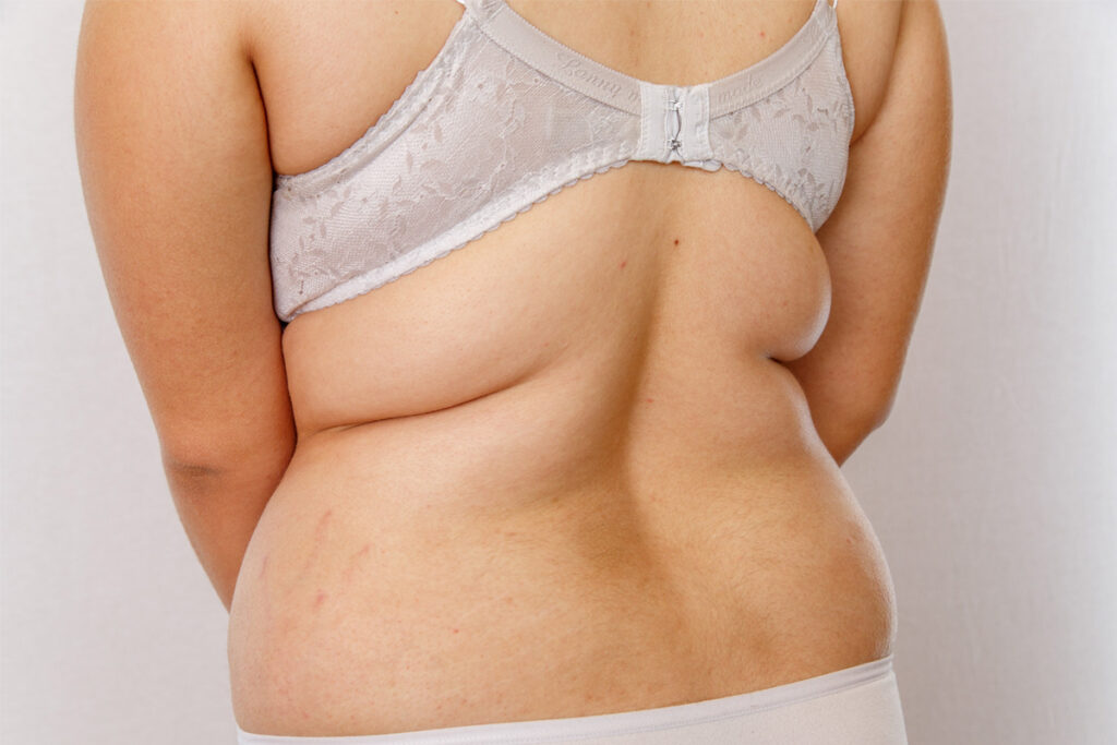 Bra Rolls Fat Removal Surgery - Gainesville Liposuction Specialist