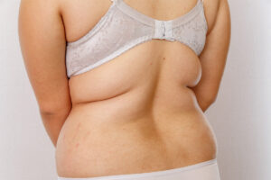 The procedure involves small incisions and a cannula to suction out fat, resulting in minimal scarring and quicker recovery.