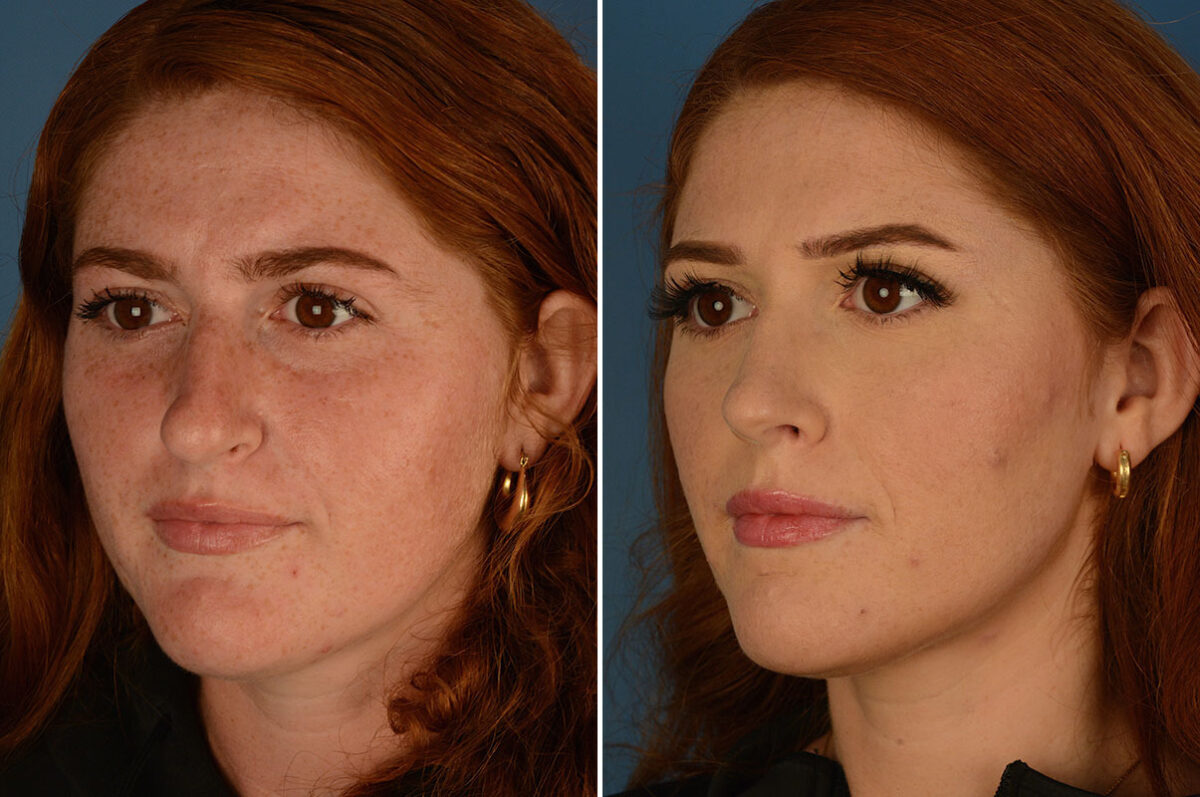 Rhinoplasty Before and After Photos in Naples, FL, Patient 25201