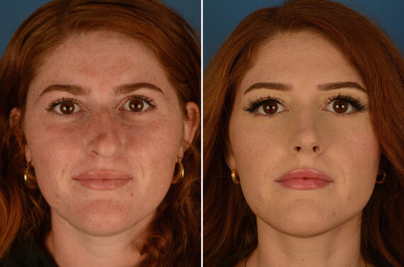 Rhinoplasty Before and After Photos in Naples, FL, Patient 25201