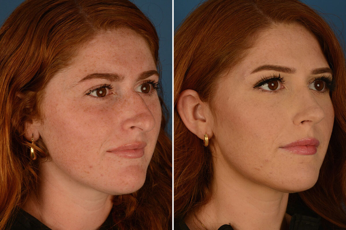Rhinoplasty Before and After Photos in Naples, FL, Patient 25201