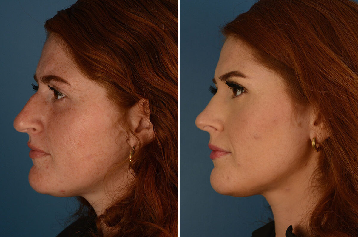 Rhinoplasty Before and After Photos in Naples, FL, Patient 25201