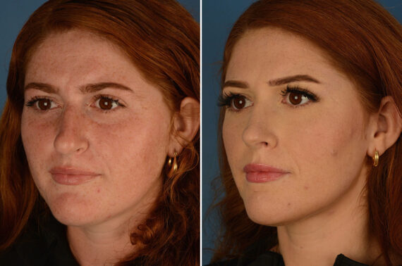 Rhinoplasty Before and After Photos in Naples, FL, Patient 25201