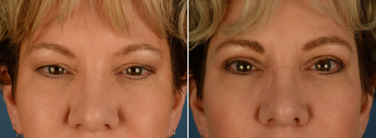 Blepharoplasty Before and After Photos in Naples, FL, Patient 25270