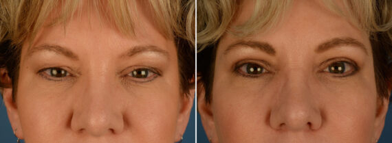 Blepharoplasty Before and After Photos in Naples, FL, Patient 25270