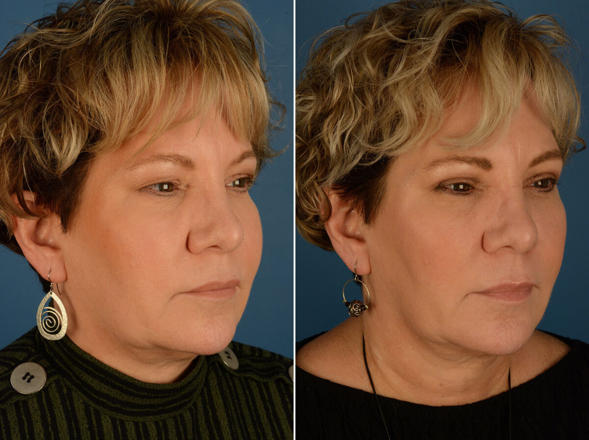Blepharoplasty Before and After Photos in Naples, FL, Patient 25270