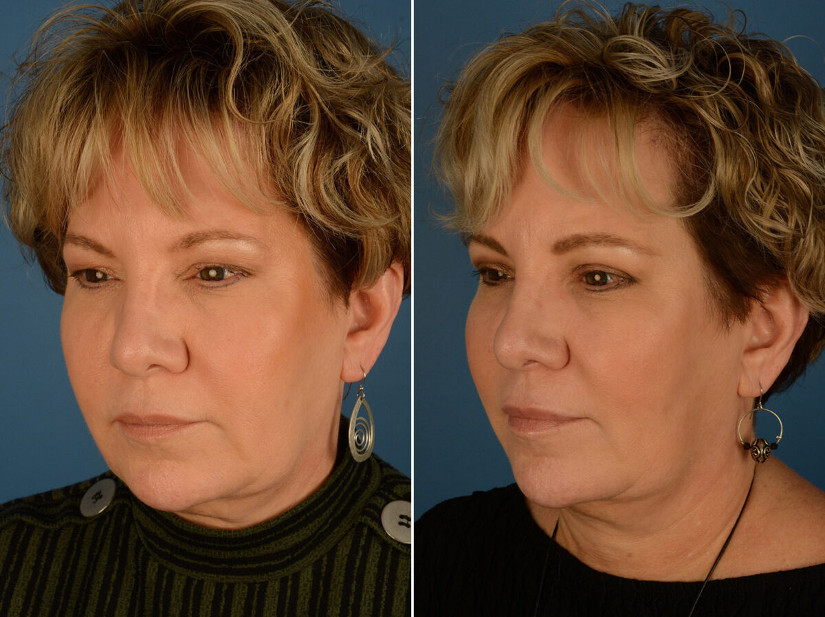 Blepharoplasty Before and After Photos in Naples, FL, Patient 25270