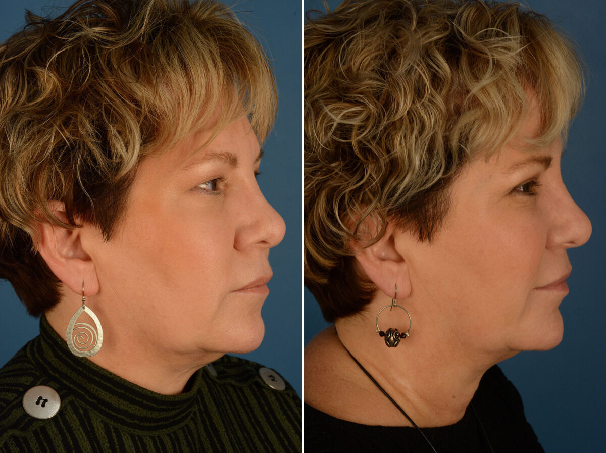 Blepharoplasty Before and After Photos in Naples, FL, Patient 25270