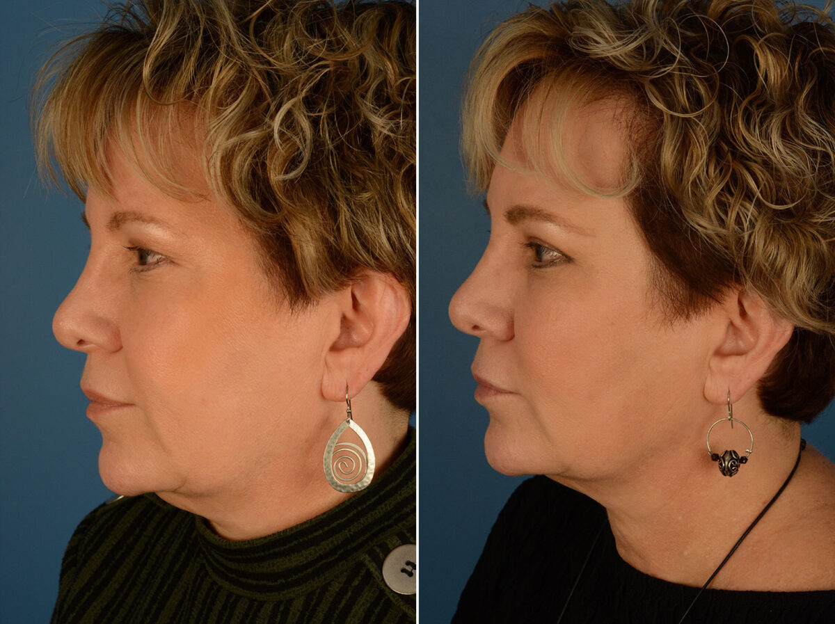 Blepharoplasty Before and After Photos in Naples, FL, Patient 25270
