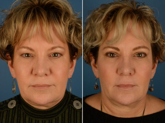 Blepharoplasty Before and After Photos in Naples, FL, Patient 25270