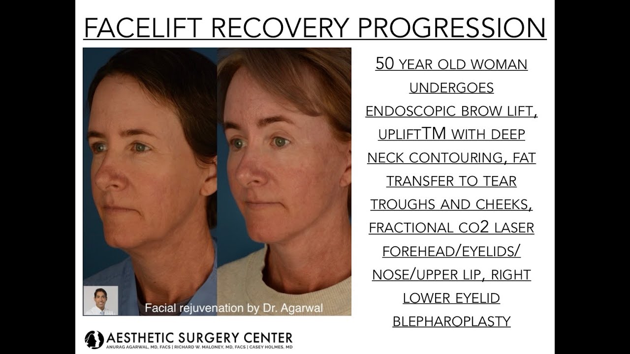 Facelift Recovery Progression by Dr. Anurag Agarwal