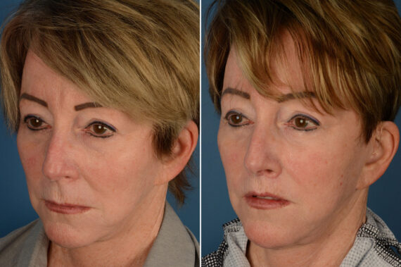 Lip Lift Before and After Photos in Naples, FL, Patient 19319