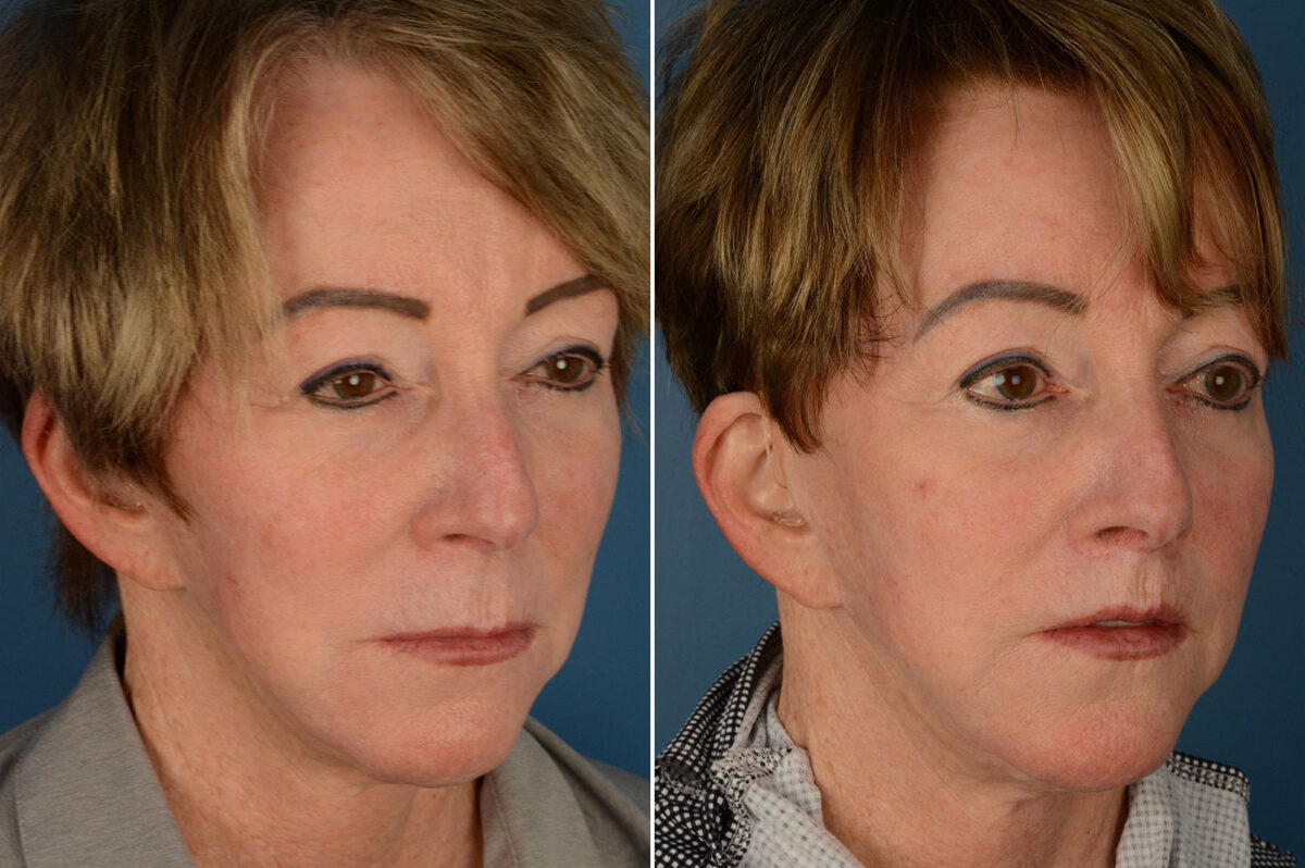 Lip Lift Before and After Photos in Naples, FL, Patient 19319
