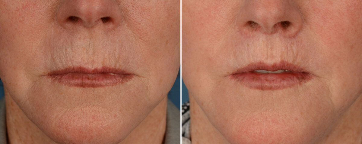 Lip Lift Before and After Photos in Naples, FL, Patient 19319