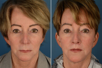 Lip Lift Before and After Photos in Naples, FL, Patient 19319