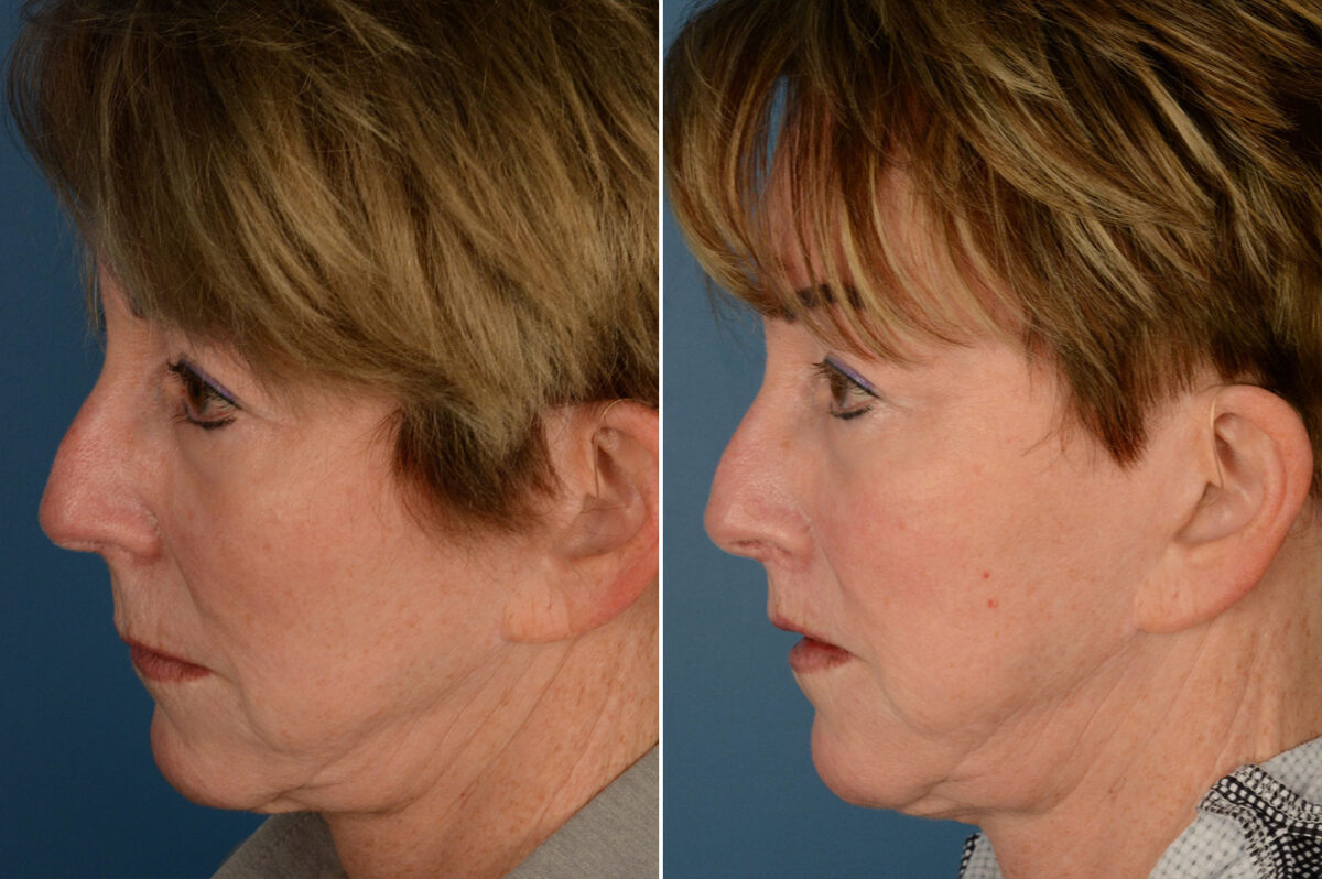 Lip Lift Before and After Photos in Naples, FL, Patient 19319