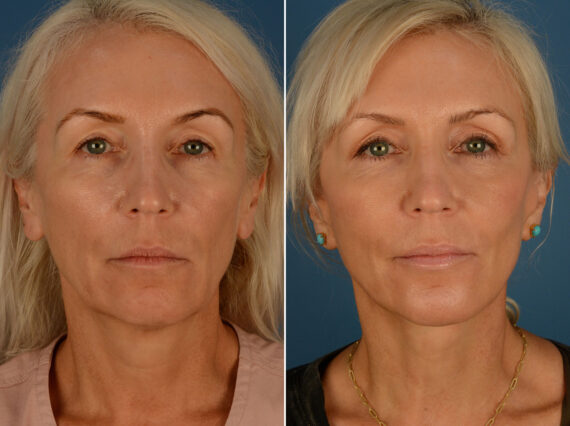 The UpLift™ Lower Face and Neck Lift Before and After Photos in Naples, FL, Patient 25292