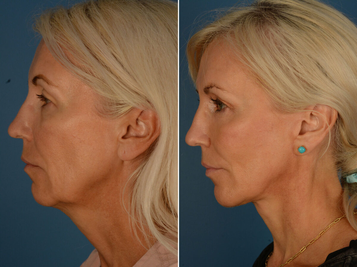 The UpLift™ Lower Face and Neck Lift Before and After Photos in Naples, FL, Patient 25292