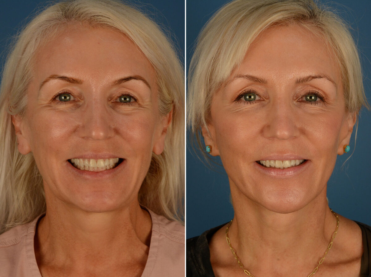 The UpLift™ Lower Face and Neck Lift Before and After Photos in Naples, FL, Patient 25292