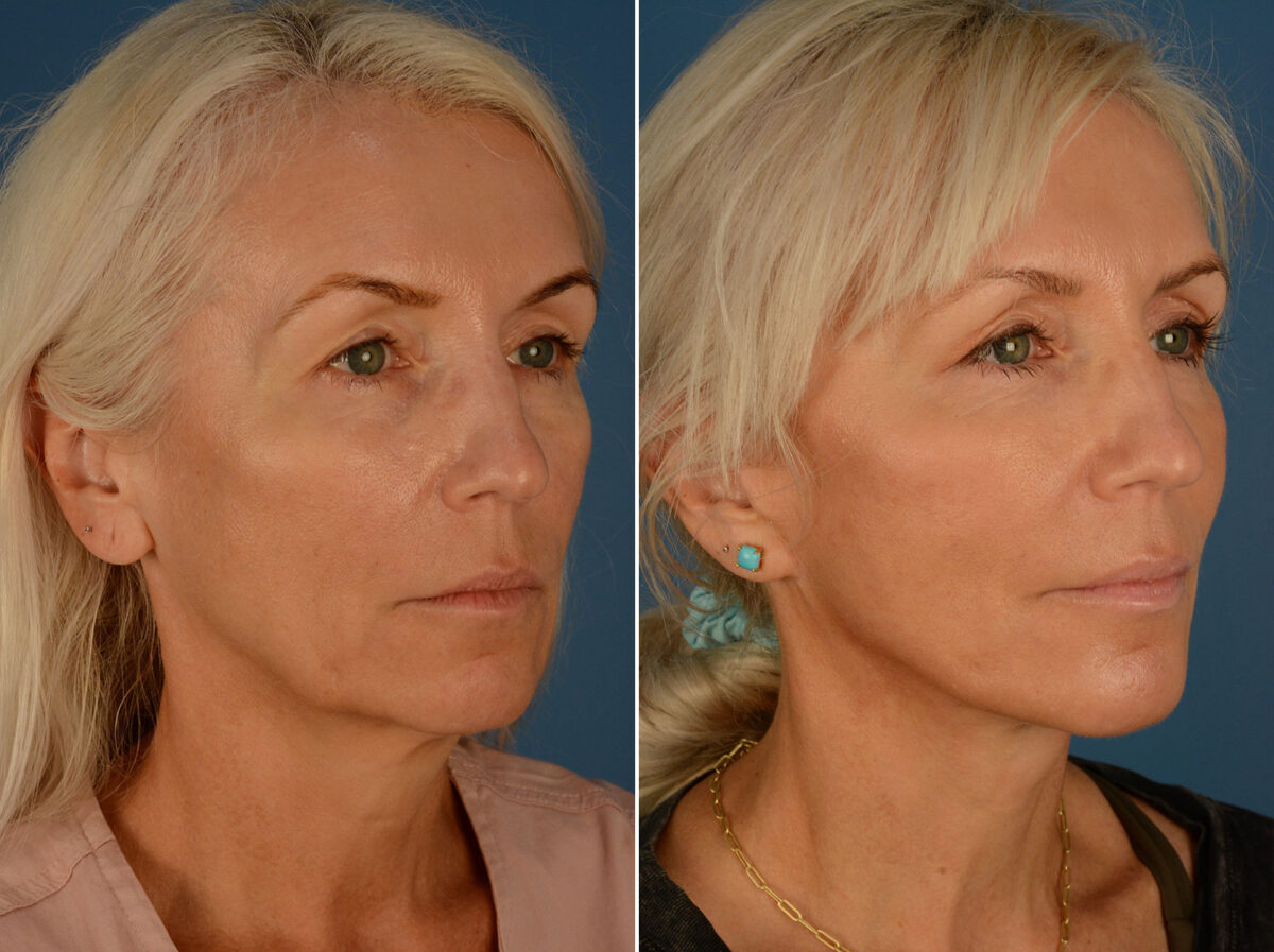 The UpLift™ Lower Face and Neck Lift Before and After Photos in Naples, FL, Patient 25292