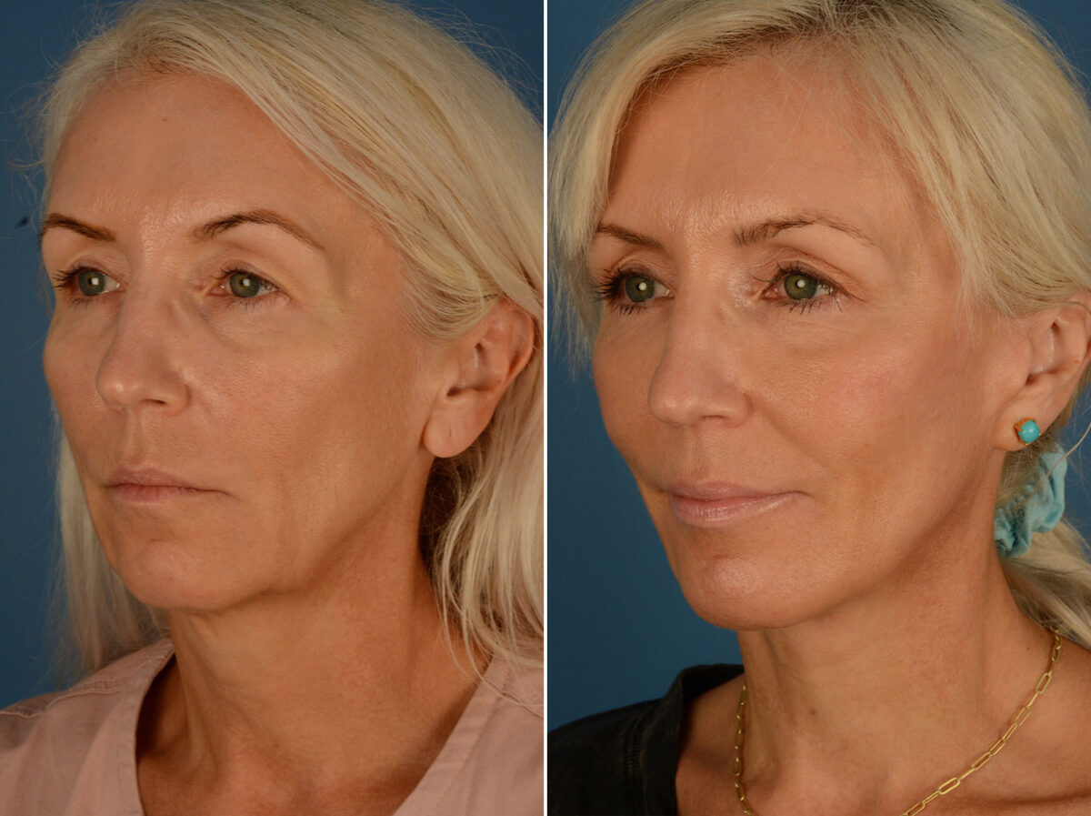 The UpLift™ Lower Face and Neck Lift Before and After Photos in Naples, FL, Patient 25292