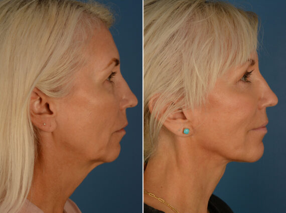 The UpLift™ Lower Face and Neck Lift Before and After Photos in Naples, FL, Patient 25292