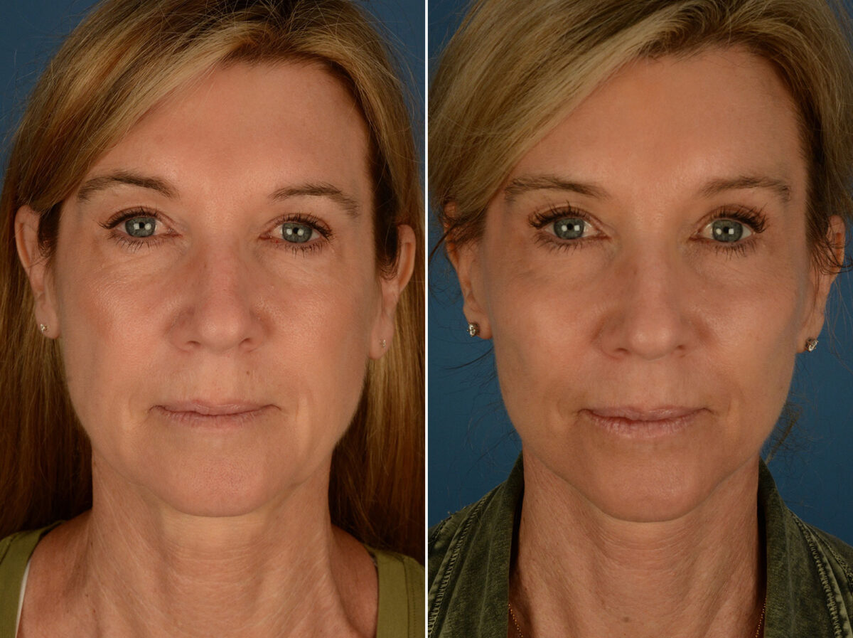 Cheek Implants Before and After Photos in Naples, FL, Patient 25314