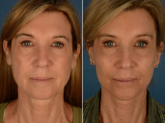 Cheek Implants Before and After Photos in Naples, FL, Patient 25314